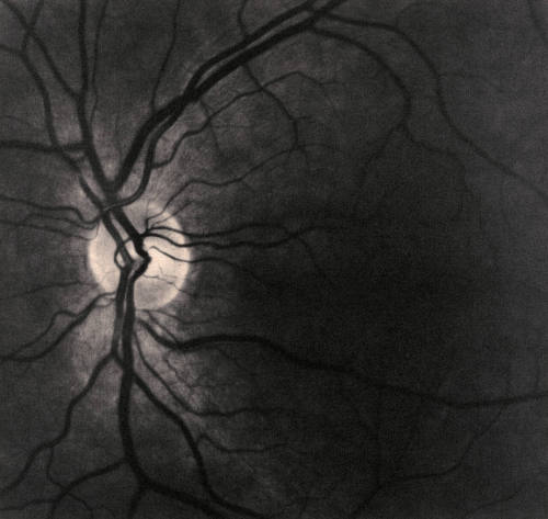 Retinas  [diptych]