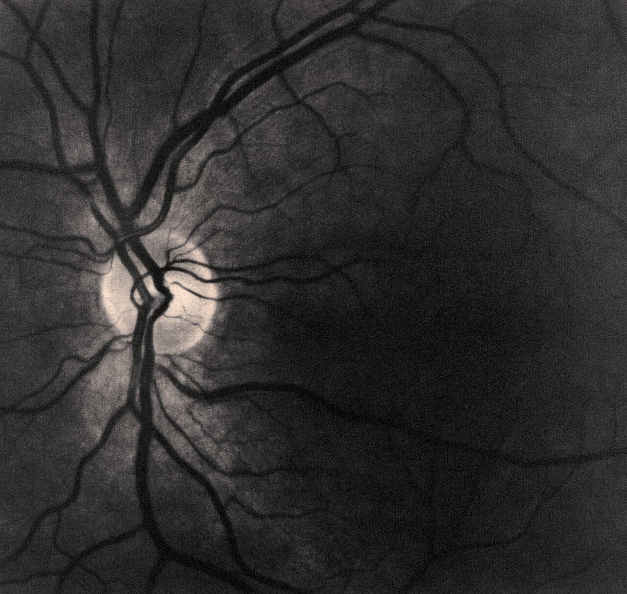 Retinas  [diptych]