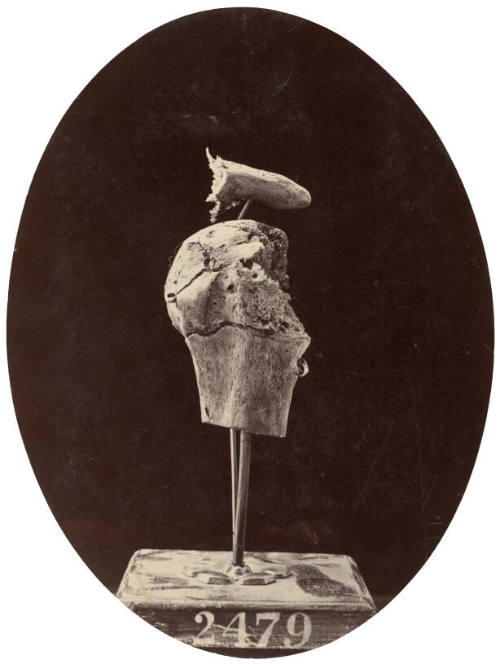Successful Excision of the Head of the Humerus