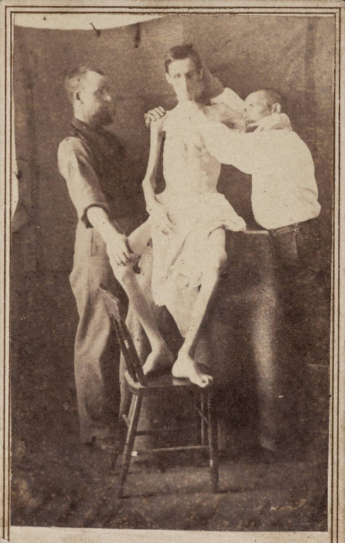 Emaciated Union soldier